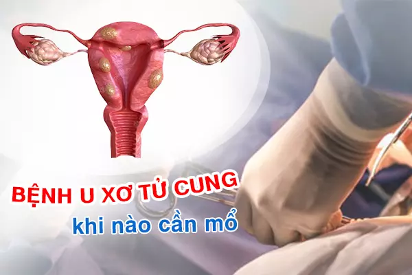 Bệnh u xơ tử cung
